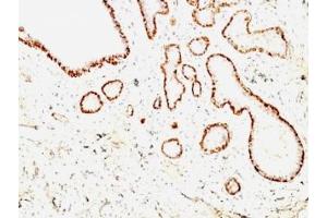 Formalin-fixed, paraffin-embedded human breast carcinoma stained with Calponin antibody (CNN1/832 + CALP). (Calponin antibody)