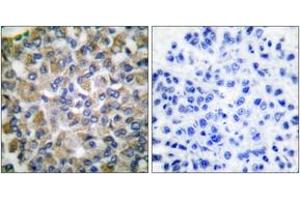 Immunohistochemistry analysis of paraffin-embedded human breast carcinoma tissue, using GRP75 Antibody. (HSPA9 antibody  (AA 630-679))