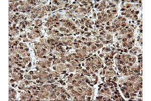 Immunohistochemical staining of paraffin-embedded Carcinoma of Human liver tissue using anti-SAMHD1 mouse monoclonal antibody. (SAMHD1 antibody)