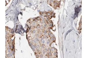 ABIN6266941 at 1/100 staining human Breast cancer tissue sections by IHC-P.