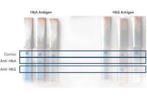 Lateral Flow Results of Anti-HbA (Hemoglobin A) and Anti-HbS (Hemoglobin beta S) Antibodies. (HbBs (N-Term) antibody)
