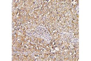 IHC analysis of NMI using anti-NMI antibody (ABIN6719489). (NMI antibody  (AA 2-307))