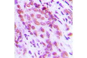 Immunohistochemical analysis of NF-kappaB p65 (pS276) staining in human breast cancer formalin fixed paraffin embedded tissue section. (NF-kB p65 antibody  (pSer276))