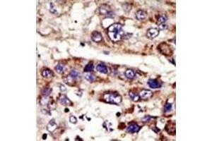 Formalin-fixed and paraffin-embedded human cancer tissue reacted with the primary antibody, which was peroxidase-conjugated to the secondary antibody, followed by DAB staining. (ZMPSTE24 antibody  (C-Term))