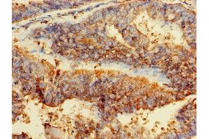 Immunohistochemistry of paraffin-embedded human endometrial cancer using ABIN7153928 at dilution of 1:100 (GPI antibody  (AA 2-554))