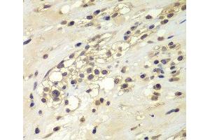 Immunohistochemistry of paraffin-embedded Human kidney cancer using CHEK1 Polyclonal Antibody at dilution of 1:100 (40x lens). (CHEK1 antibody)