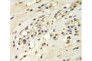 Immunohistochemistry of paraffin-embedded Human kidney cancer using CHEK1 Polyclonal Antibody at dilution of 1:100 (40x lens).