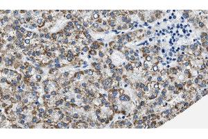 ABIN6275941 at 1/100 staining Human liver cancer tissue by IHC-P. (PTGER3 antibody  (C-Term))