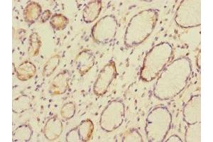 Immunohistochemistry of paraffin-embedded human colon cancer using ABIN7146794 at dilution of 1:100 (CEACAM4 antibody  (AA 36-155))