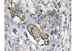 Immunohistochemical analysis of paraffin-embedded human lung cancer tissue using AQP5 polyclonal antibody .