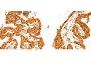 Immunohistochemistry of paraffin-embedded Human thyroid cancer tissue using GANC Polyclonal Antibody at dilution of 1:55(x200) (GANC antibody)