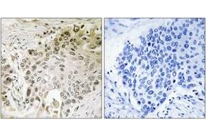 Immunohistochemistry analysis of paraffin-embedded human lung carcinoma, using RFX2 Antibody. (RFX2 antibody  (AA 661-710))