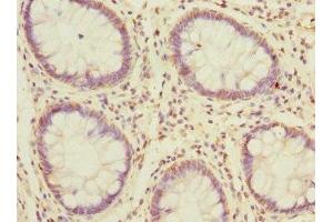 Immunohistochemistry of paraffin-embedded human colon cancer using ABIN7159601 at dilution of 1:100 (MSRB2 antibody  (AA 10-182))