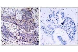 Immunohistochemical analysis of paraffin-embedded human breast carcinoma tissue using BAD (Ab-136) antibody (E021063). (BAD antibody)