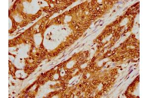 IHC image of nme1HU diluted at 1:5 and staining in paraffin-embedded human colon cancer performed on a Leica BondTM system. (Histone H2B antibody  (AA 76-87))
