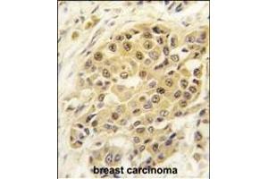 Formalin-fixed and paraffin-embedded human breast carcinoma tissue reacted with SENP3 antibody (N-term) (ABIN388047 and ABIN2845593) , which was peroxidase-conjugated to the secondary antibody, followed by DAB staining. (SENP3 antibody  (N-Term))