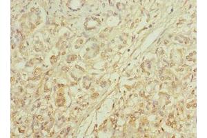 Immunohistochemistry of paraffin-embedded human pancreatic cancer using ABIN7146098 at dilution of 1:100 (MRC2 antibody  (AA 120-300))