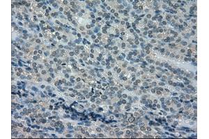 Immunohistochemical staining of paraffin-embedded Carcinoma of kidney tissue using anti-DHFRmouse monoclonal antibody.