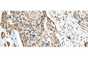 Immunohistochemistry of paraffin-embedded Human esophagus cancer tissue using CBFB Polyclonal Antibody at dilution of 1:40(x200) (CBFB antibody)