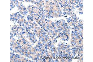 Immunohistochemistry of Human liver cancer using KCNH8 Polyclonal Antibody at dilution of 1:50 (KCNH8 antibody)
