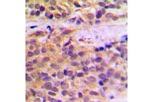 Immunohistochemical analysis of RAB11FIP1 staining in human prostate cancer formalin fixed paraffin embedded tissue section. (RAB11FIP1 antibody  (N-Term))