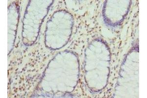 Immunohistochemistry of paraffin-embedded human colon cancer using ABIN7149288 at dilution of 1:100 (Cytohesin 2 antibody  (AA 150-350))