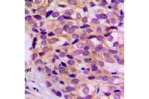 Immunohistochemical analysis of ATP5G1 staining in human breast cancer formalin fixed paraffin embedded tissue section. (ATP5G1 antibody  (Center))