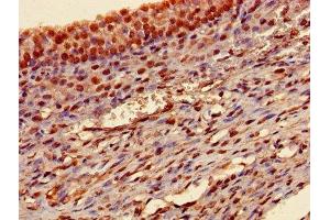 Immunohistochemistry of paraffin-embedded human ovarian cancer using ABIN7172847 at dilution of 1:100 (Transgelin antibody  (AA 2-201))