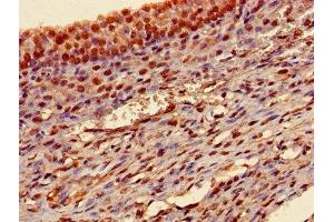 Immunohistochemistry of paraffin-embedded human ovarian cancer using ABIN7172847 at dilution of 1:100
