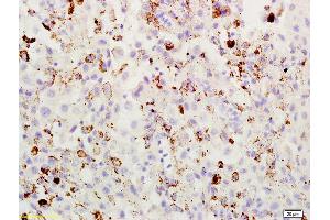 Formalin-fixed and paraffin embedded mouse melanoma labeled with Rabbit Anti ABCB5 Polyclonal Antibody, Unconjugated (ABIN731933) at 1:200 followed by conjugation to the secondary antibody and DAB staining (ABCB5 antibody  (AA 841-883))