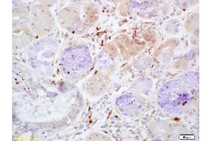 Formalin-fixed and paraffin embedded human lung carcinoma with labeled Anti-Properdin Polyclonal Antibody, Unconjugated (ABIN1386799) at 1:200, followed by conjugation to the secondary antibody and DAB staining