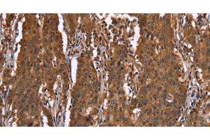 Immunohistochemistry of paraffin-embedded Human gastic cancer using HINT1 Polyclonal Antibody at dilution of 1:30