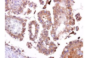 IHC-P Image TATDN1 antibody [N1C2] detects TATDN1 protein at cytosol on human ovarian carcinoma by immunohistochemical analysis. (TATDN1 antibody  (Center))