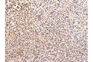 The image on the left is immunohistochemistry of paraffin-embedded Human prostate cancer tissue using ABIN7192170(RERE Antibody) at dilution 1/20, on the right is treated with synthetic peptide. (RERE antibody)