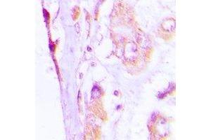 Immunohistochemical analysis of CAP18 staining in human lung cancer formalin fixed paraffin embedded tissue section.