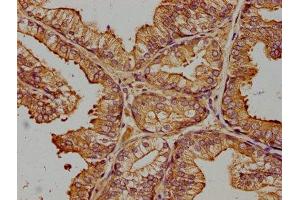 IHC image of ABIN7174401 diluted at 1:400 and staining in paraffin-embedded human prostate cancer performed on a Leica BondTM system. (ZRANB1 antibody  (AA 111-397))