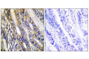 Immunohistochemistry analysis of paraffin-embedded human colon carcinoma tissue, using DGKH antibody. (DGKH antibody  (Internal Region))