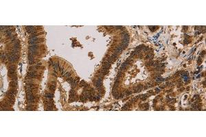 Immunohistochemistry of paraffin-embedded Human colon cancer tissue using CSNK2B Polyclonal Antibody at dilution of 1:30(x200) (CSNK2B antibody)