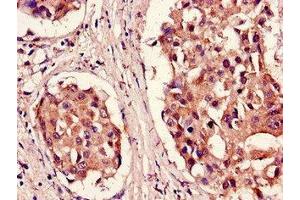 Immunohistochemistry of paraffin-embedded human breast cancer using ABIN7164982 at dilution of 1:100 (PSMB5 antibody  (AA 106-188))