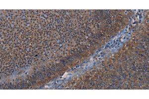 Immunohistochemistry of paraffin-embedded Human rectal cancer using P3H3 Polyclonal Antibody at dilution of 1:50 (LEPREL2 antibody)