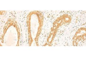 Immunohistochemistry of paraffin-embedded Human breast cancer tissue using ST8SIA4 Polyclonal Antibody at dilution of 1:50(x200) (ST8SIA4 antibody)