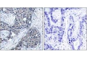 Immunohistochemistry analysis of paraffin-embedded human breast carcinoma, using eIF4E (Phospho-Ser209) Antibody.