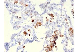 Formalin-fixed, paraffin-embedded human Lung Adenocarcinoma stained with Napsin A Mouse Monoclonal Antibody (NAPSA/3306).