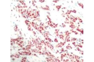 Immunohistochemistry of paraffin-embedded Human breast carcinoma using Phospho-NFkB p100(S866) Polyclonal Antibody (NFKB2 antibody  (pSer866))