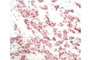 Immunohistochemistry of paraffin-embedded Human breast carcinoma using Phospho-NFkB p100(S866) Polyclonal Antibody (NFKB2 antibody  (pSer866))