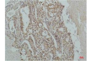 Immunohistochemistry (IHC) analysis of paraffin-embedded Human Lung Carcinoma using IkappaB beta(Monoclonal Antibody diluted at 1:200. (NFKBIB antibody)