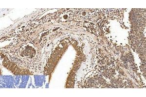 Immunohistochemistry of paraffin-embedded Human lung cancer tissue using Cleaved-PARP1 (D214) Polyclonal Antibody at dilution of 1:200. (PARP1 antibody  (Cleaved-Asp214))