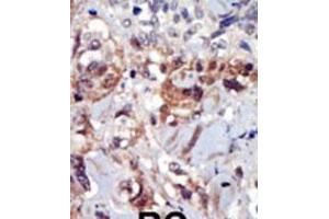 Formalin-fixed and paraffin-embedded human cancer tissue reacted with the primary antibody, which was peroxidase-conjugated to the secondary antibody, followed by AEC staining. (PIP4K2A antibody  (C-Term))