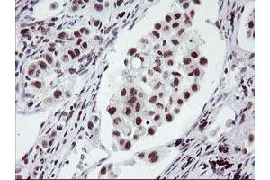 Immunohistochemical staining of paraffin-embedded Carcinoma of Human lung tissue using anti-RNF113B mouse monoclonal antibody. (RNF113B antibody)