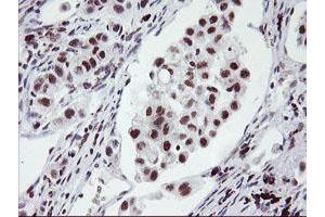 Immunohistochemical staining of paraffin-embedded Carcinoma of Human lung tissue using anti-RNF113B mouse monoclonal antibody. (RNF113B antibody)